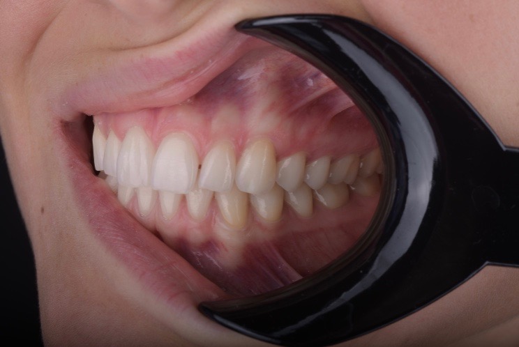 4 ACCESSORI INDISPENSABILI PER LA FOTOGRAFIA DENTALE - Dental Photographers